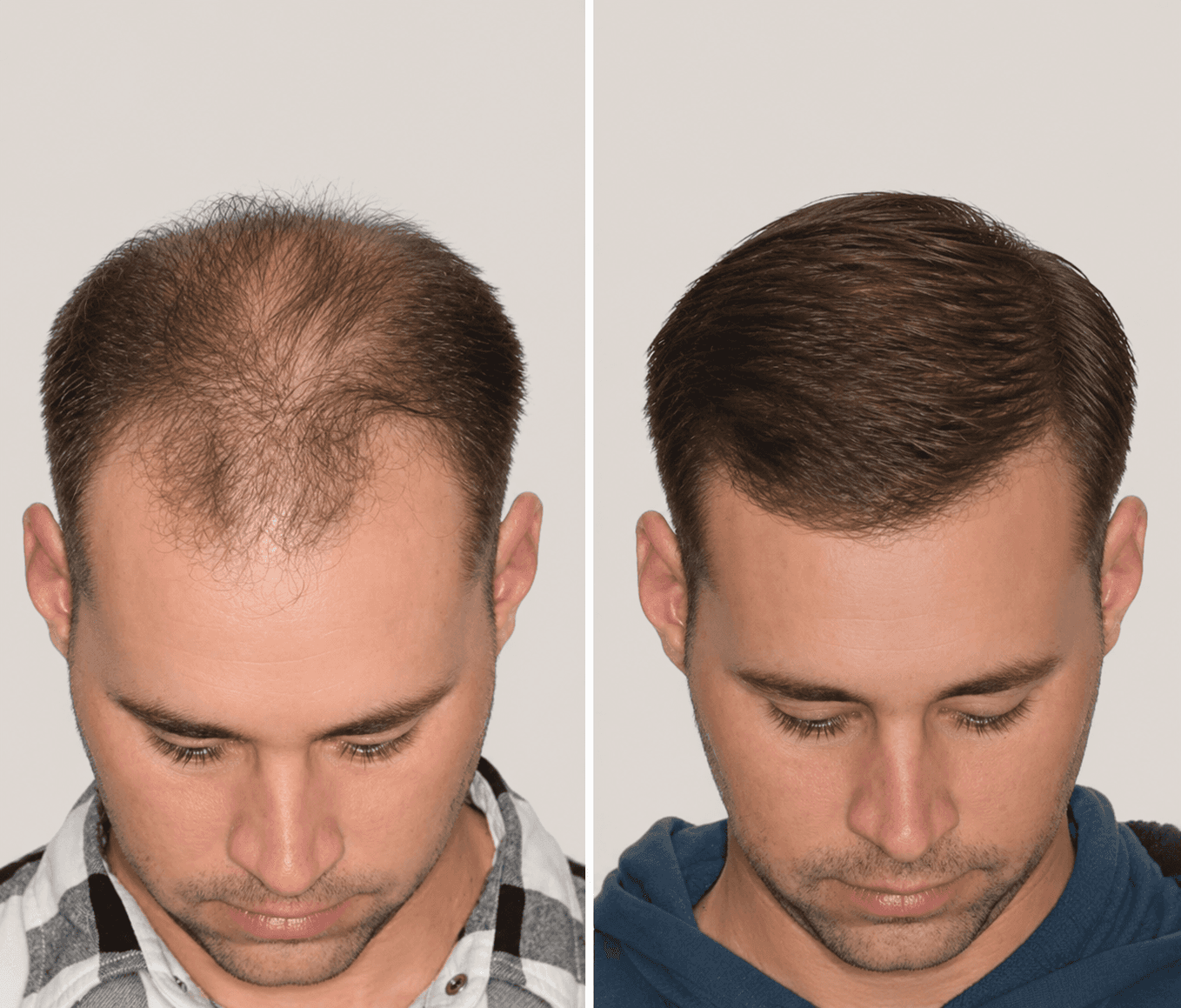 Top-down comparison photograph of a man. Left: significant crown thinning. Right: restored density across the crown and hairline.