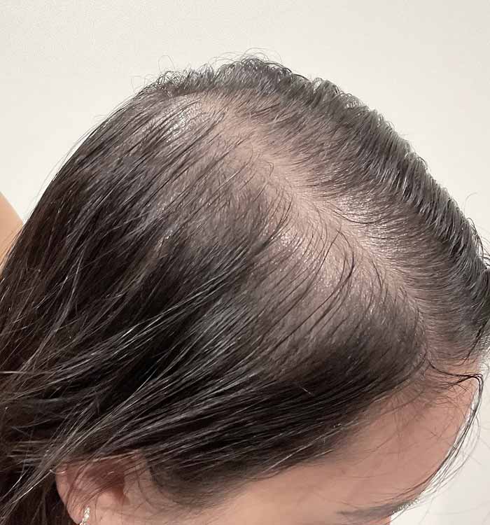 Female, 32, before