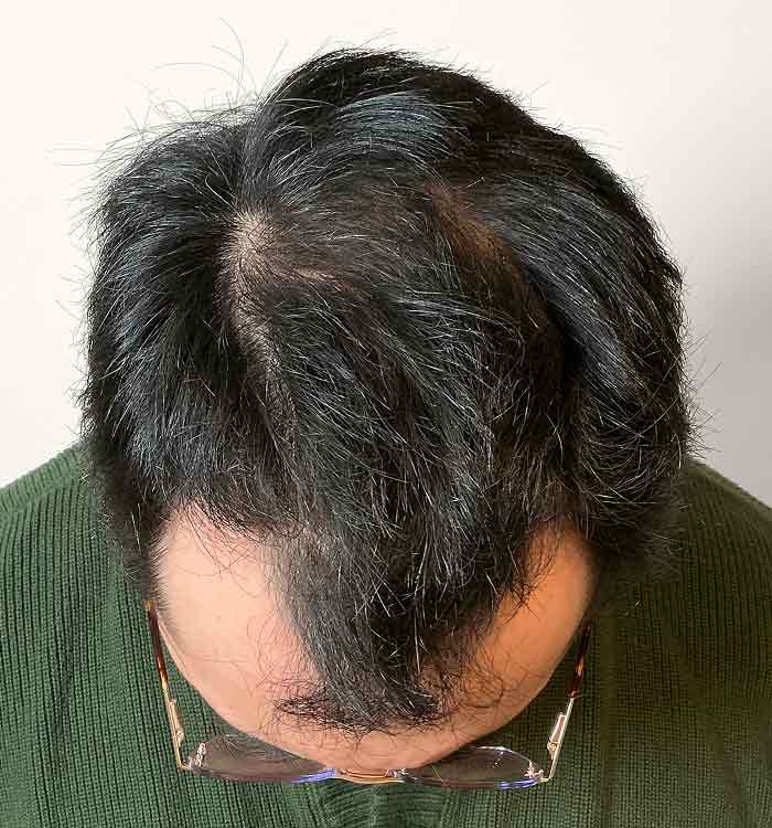 Male, 30, after